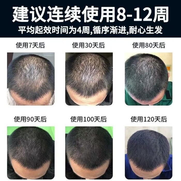 Kirkland 5% Minoxidil For Men's Hair Growth